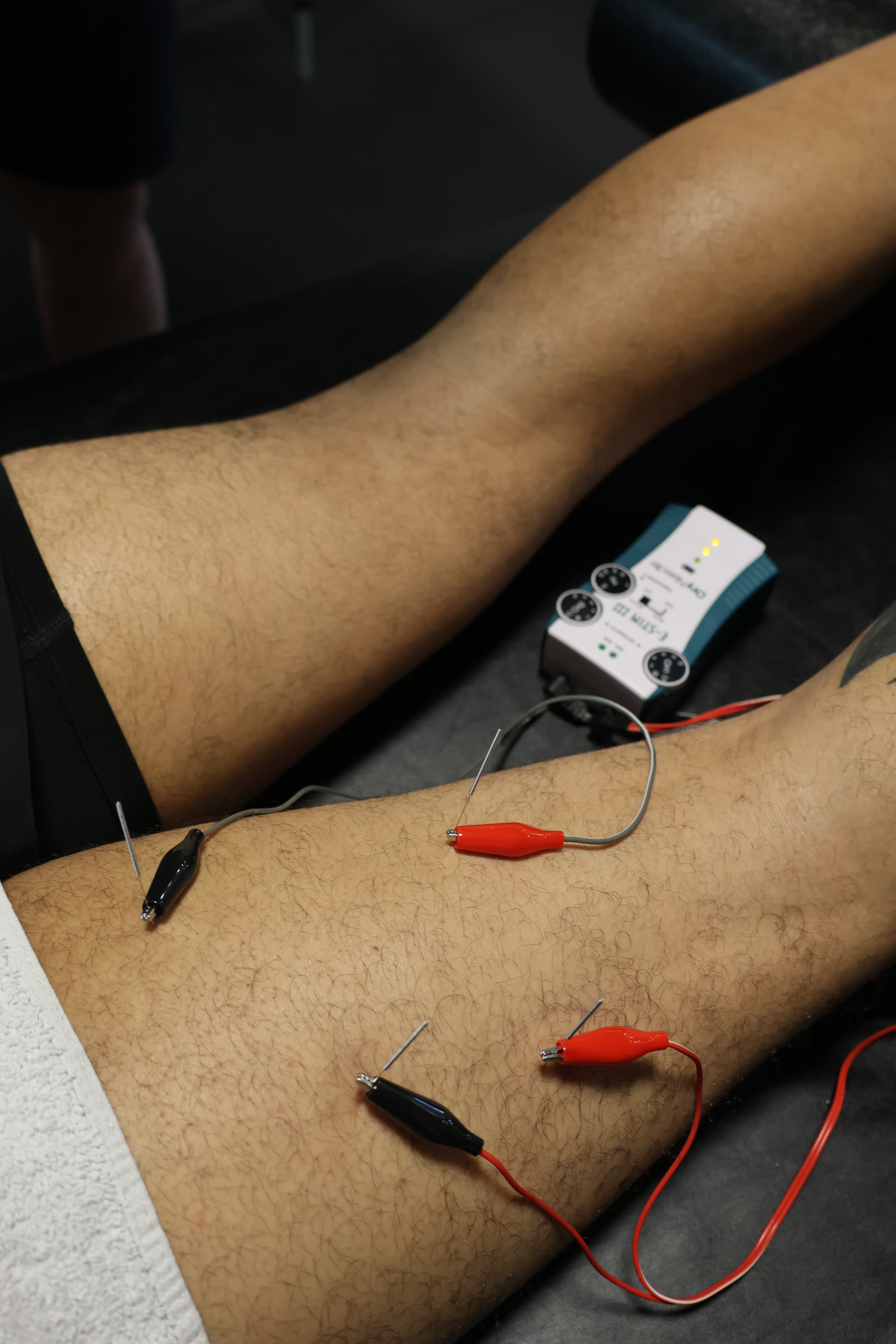 Functional Dry Needling